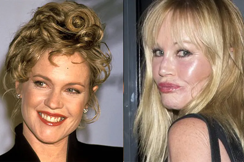 melanie griffith plastic surgery