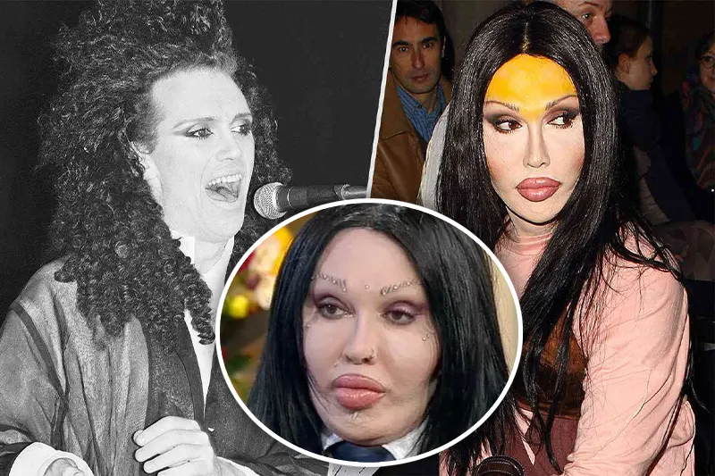 pete burns plastic surgery