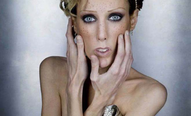 10 Most Shocking Cases of Anorexia