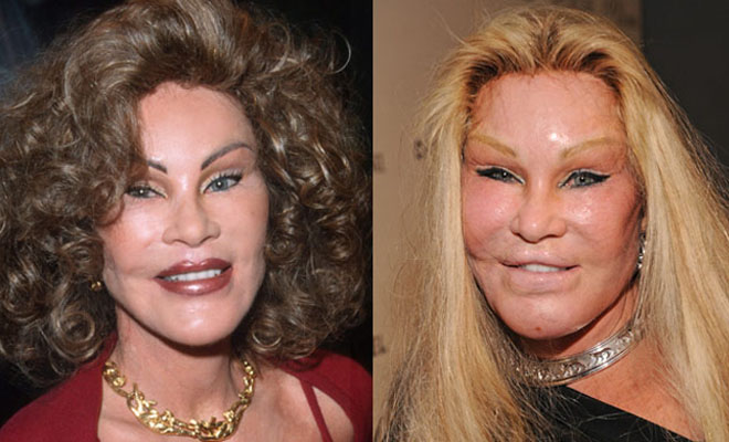 10 Worst Celebrity Plastic Surgery Disasters