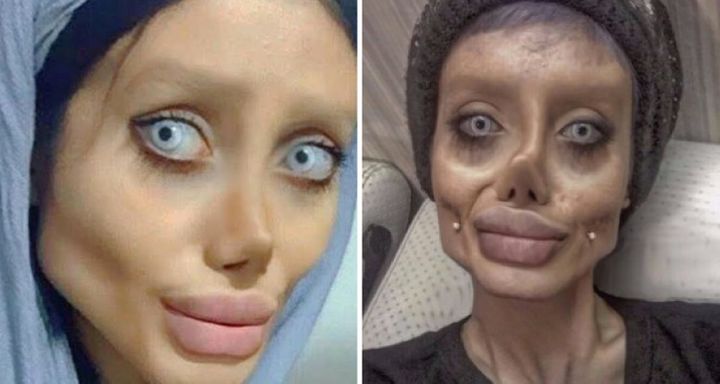 20 Most Disturbing Body Parts After Plastic Surgery Gone Wrong